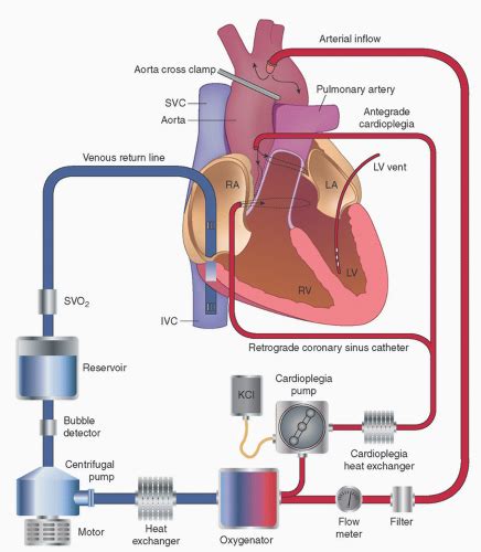 centrifugal pump in cardiopulmonary bypass|cardiopulmonary bypass circuit diagram.